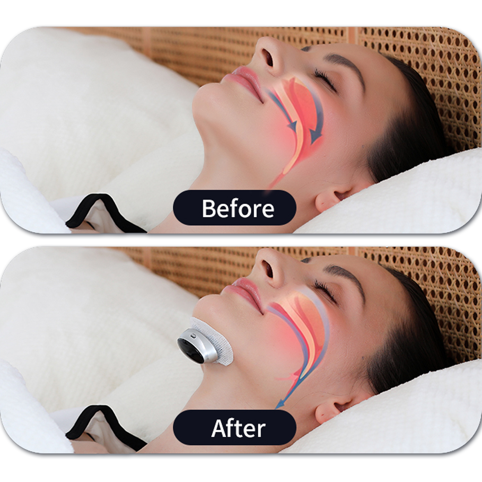 Before and after comparison of a facial treatment with a Meacode Smart Anti Snoring Device on a person's face.
